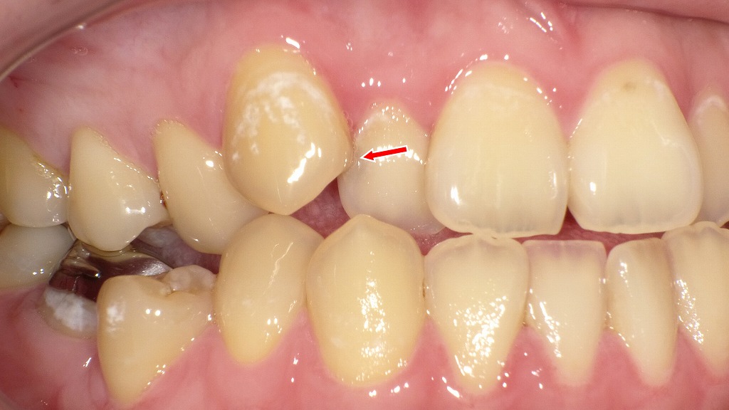 八重歯と２番にできた虫歯の症例