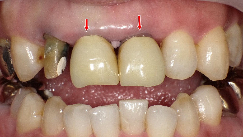 保険適用の硬質レジン前装冠