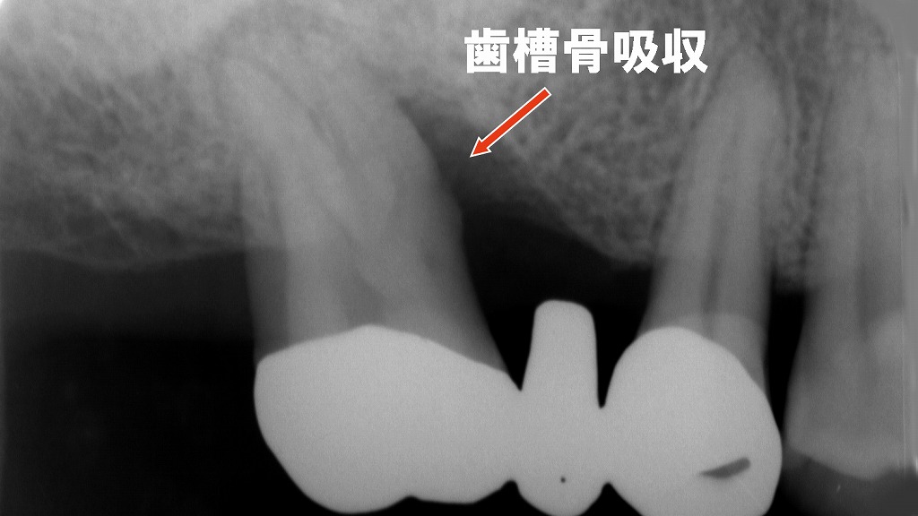 ブリッジを支える歯の歯槽骨が吸収