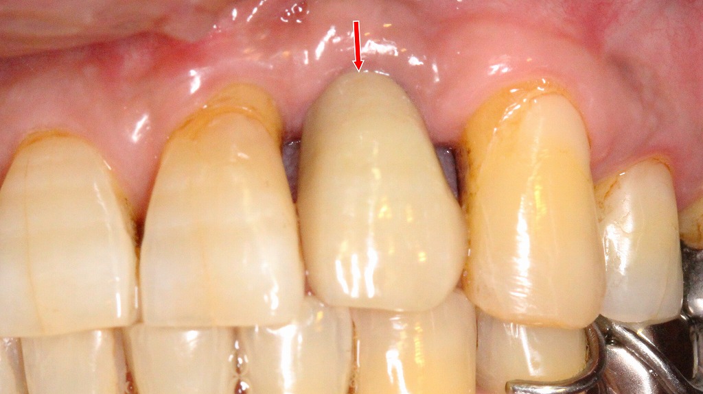 左上2番 インプラント治療:ジルコニアセラミック上部構造の装着