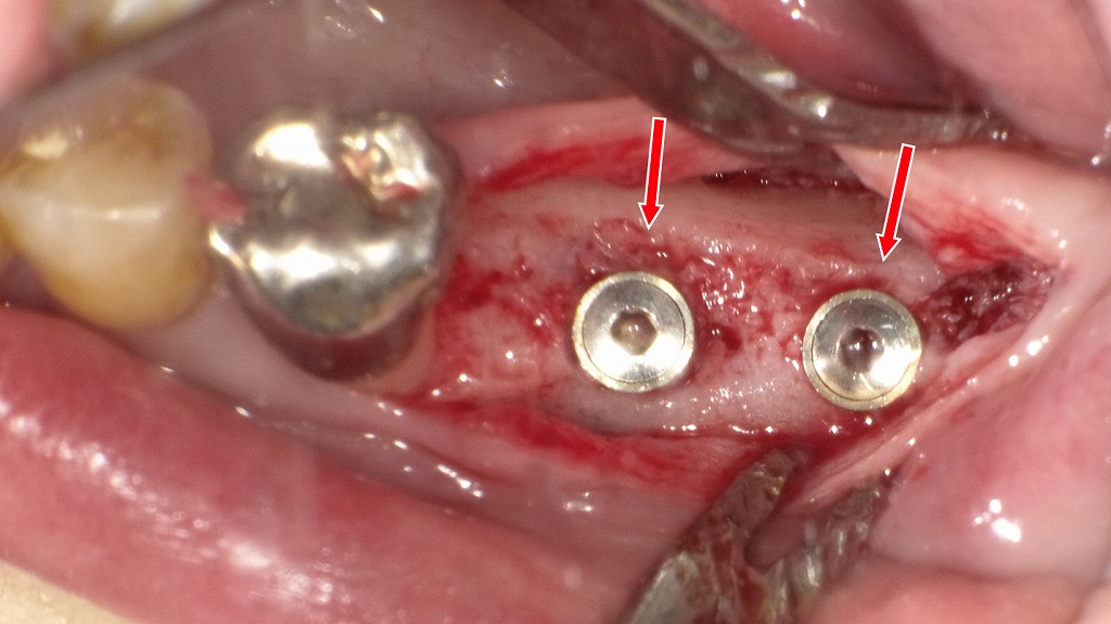 インプラント埋入手術