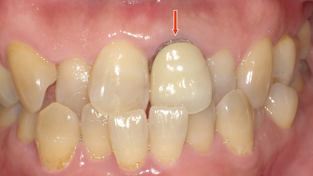 メタルボンド冠のブラックマージン