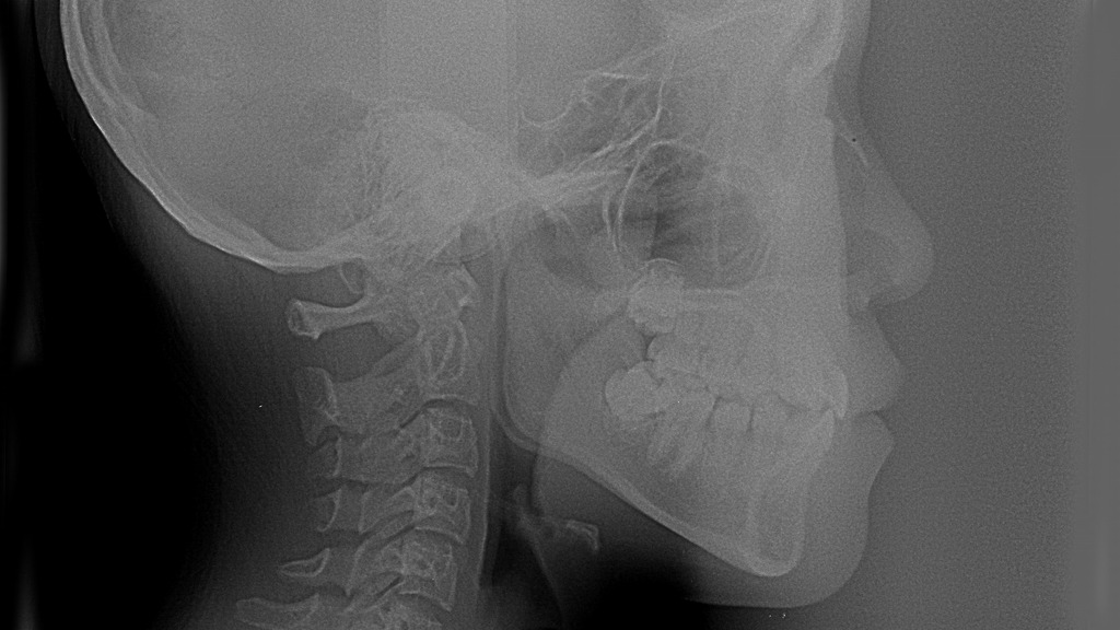 セファロ（頭部X線）による精密診断