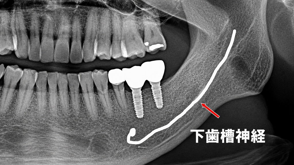 術後：上部構造装着後のパントモレントゲン所見