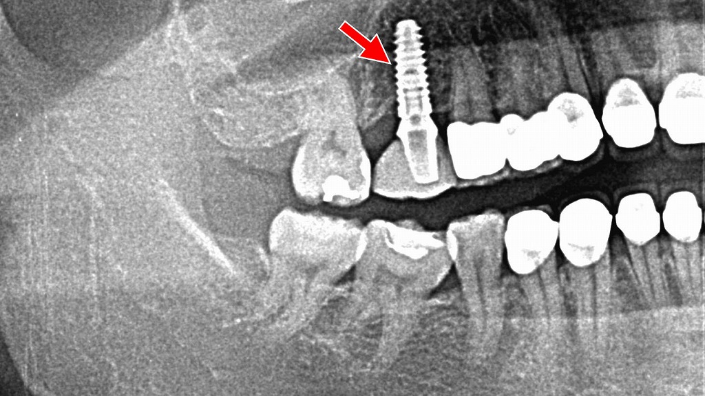 上顎6番インプラント埋入後のレントゲン所見（術後）