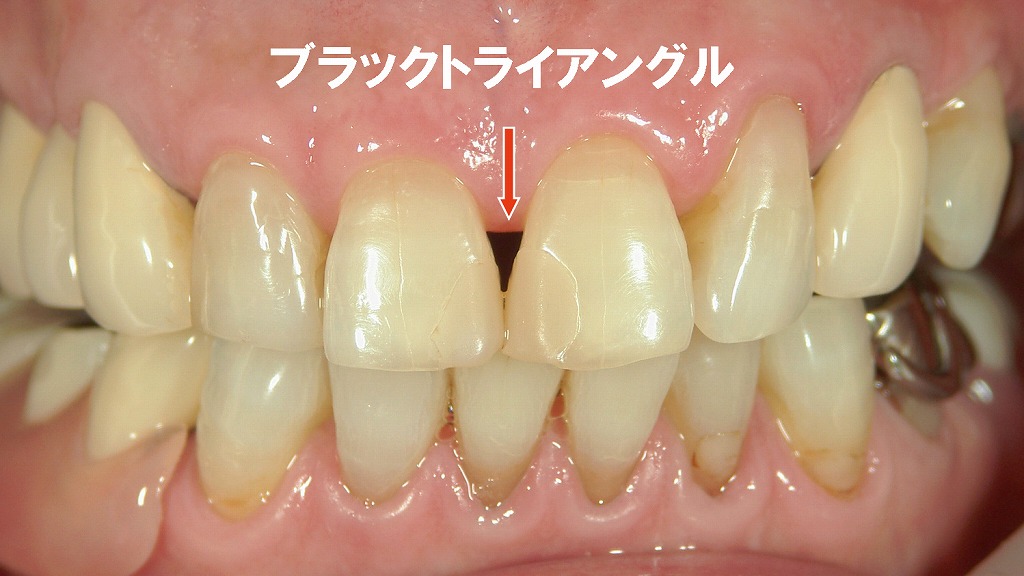 ブラックトライアングル