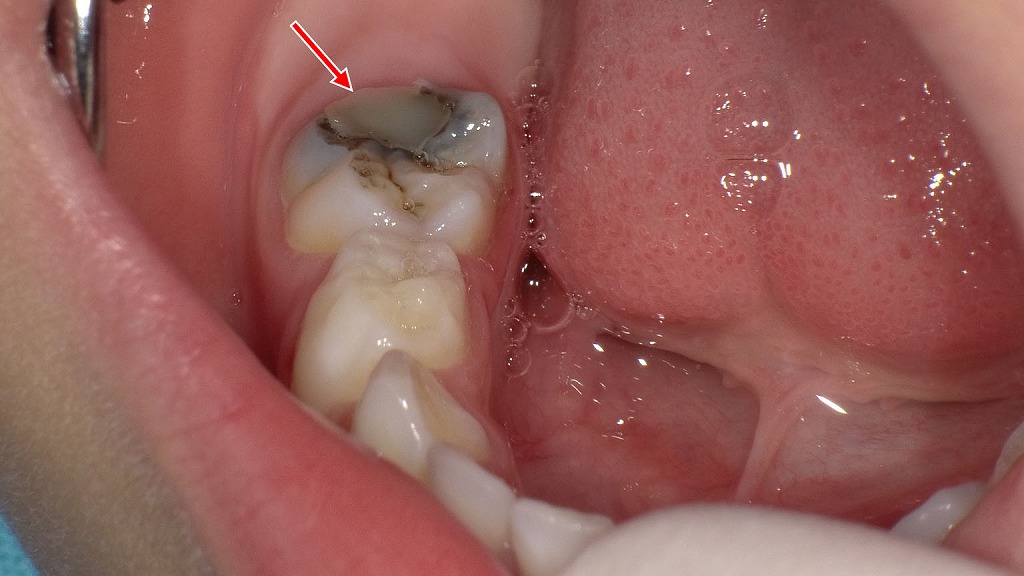 乳歯の虫歯リスクが高い時期に有効なシーラントが推奨される症例