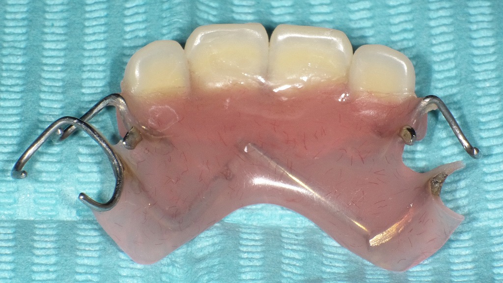 ワイヤークラスプ