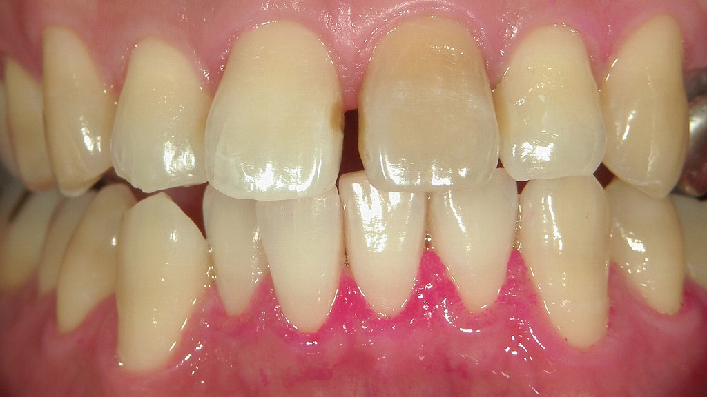 ラミネートベニアで前歯のすきっ歯を自然に改善。