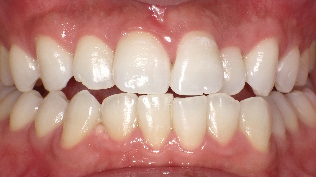 2枚目:ホワイトニング後の歯