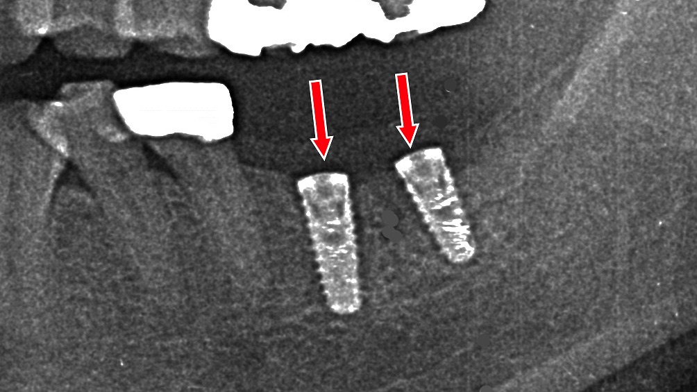 埋入した2本のインプラントの術後パノラマ画像