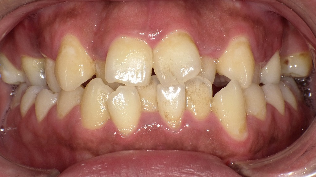 噛み合わせ異常の症例：正面観