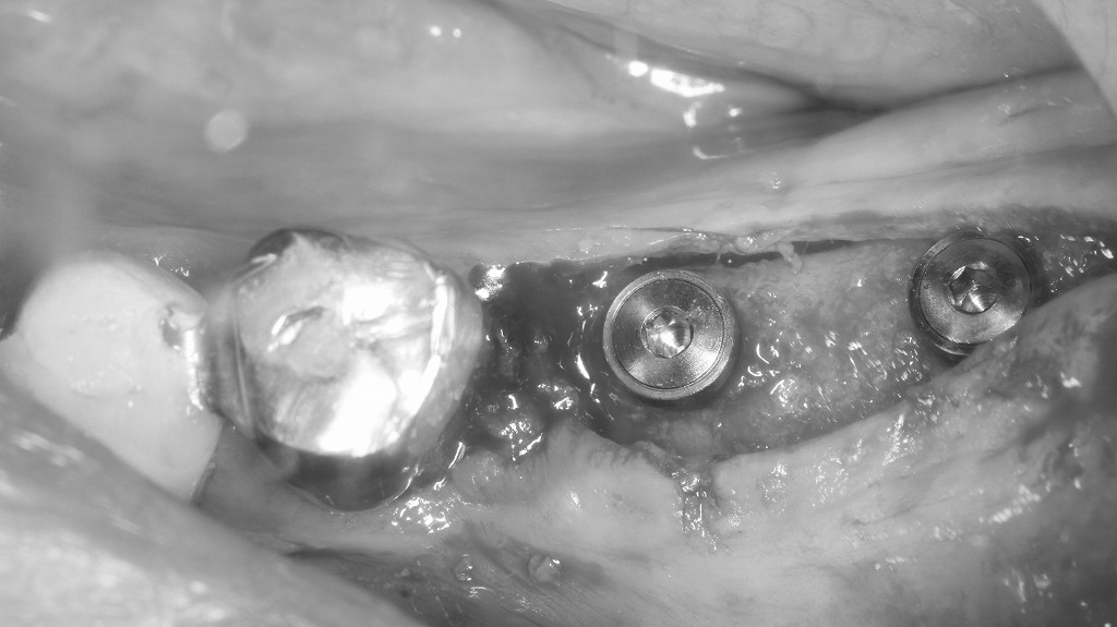 インプラント埋入の症例