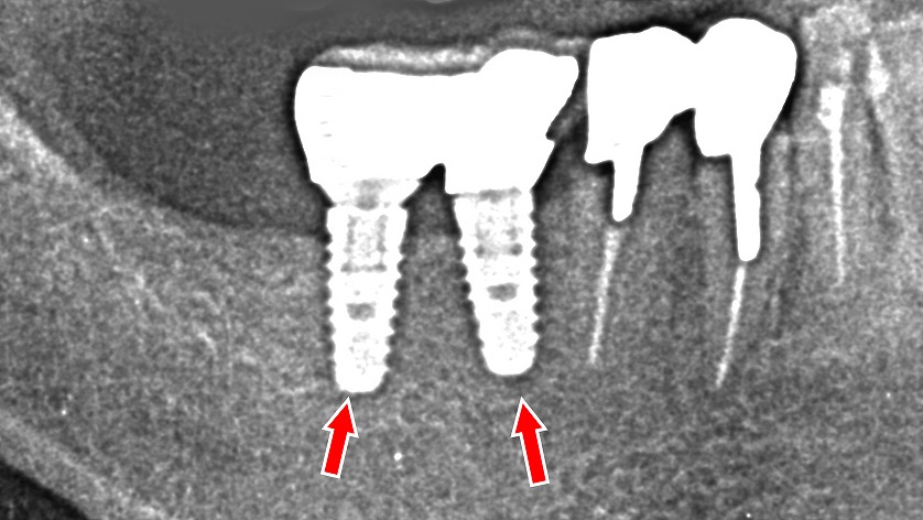 赤矢印：7番・6番インプラントが良好に骨結合し、上部構造（かぶせ物）装着後の安定した状態を示している。