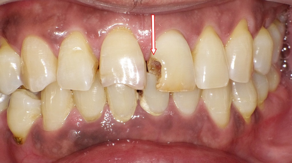 中程度に欠けた症例