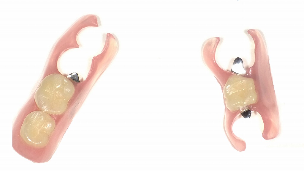 ノンクラスプデンチャー（部分入れ歯）