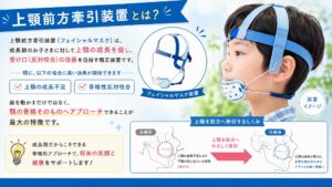 上顎前方牽引装置