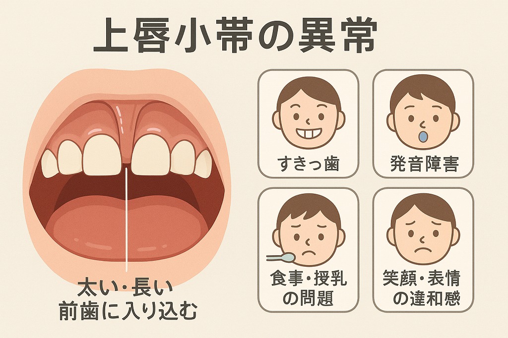 【図解あり】上唇小帯の異常とは?症状・矯正への影響・手術の必要性までわかりやすく!