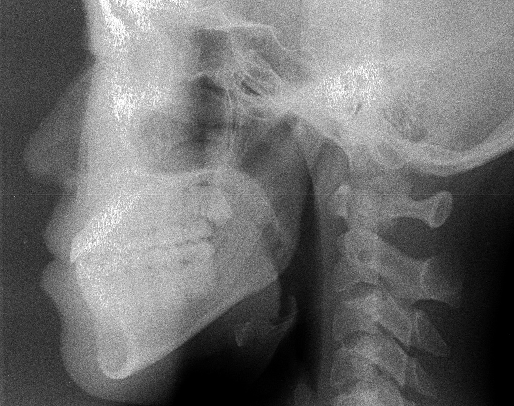 骨格性の受け口