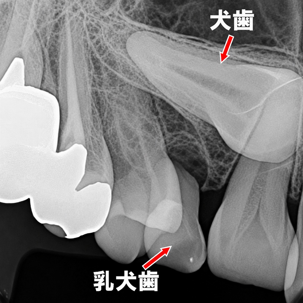 永久犬歯が埋伏し、乳犬歯の脱落が遅れている様子を示したデンタルX線画像。