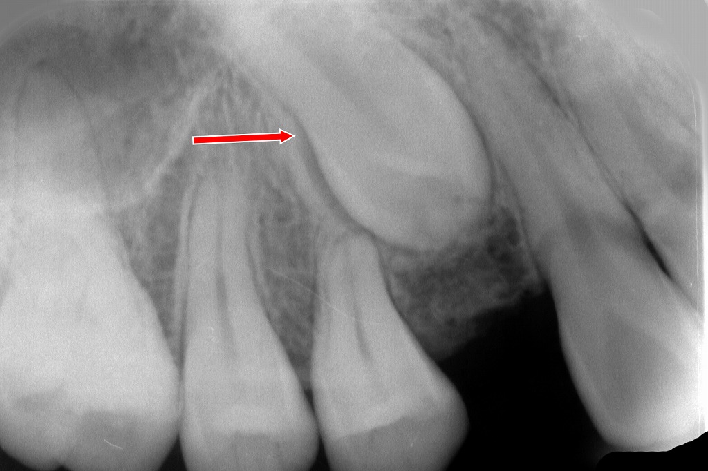 上顎犬歯の埋伏