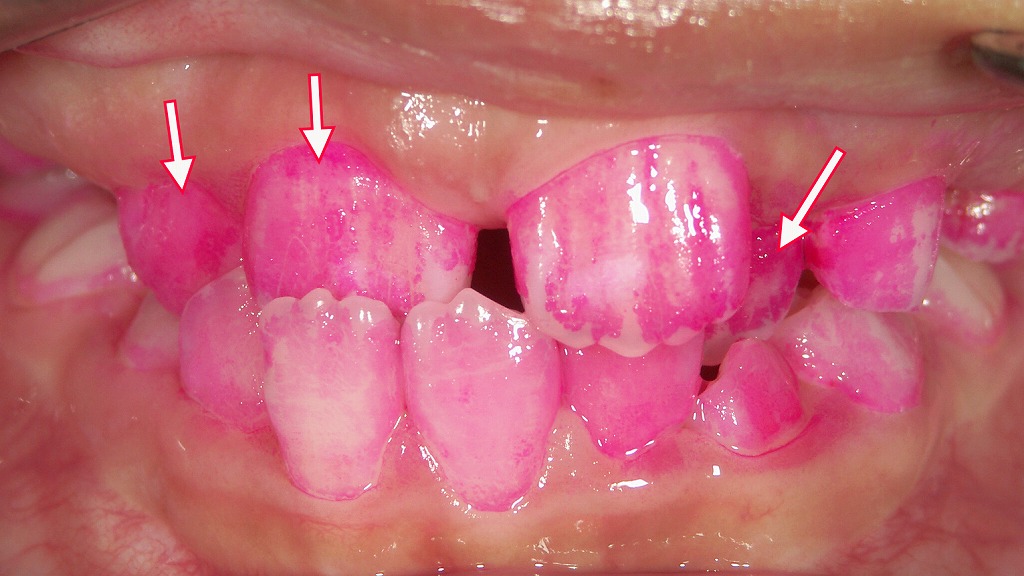 歯槽性の反対咬合