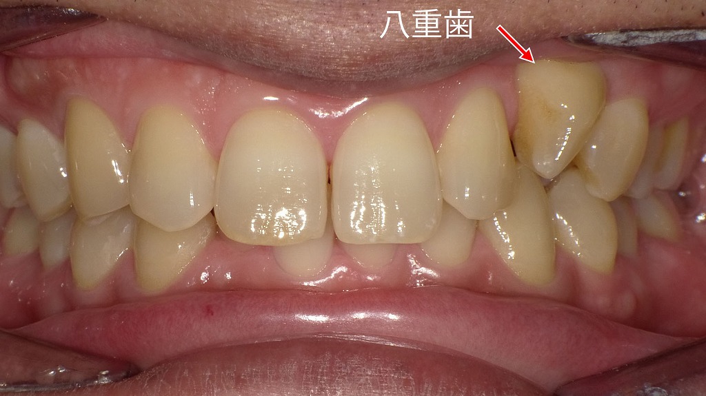 乳歯が抜けないことで起こる八重歯（叢生）