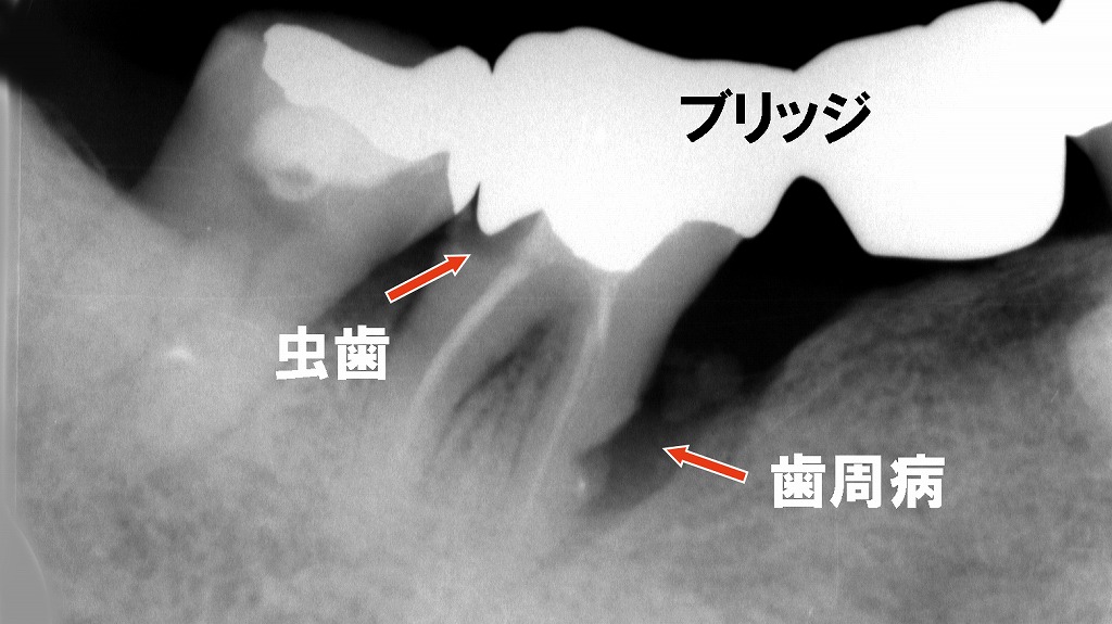 虫歯・歯周病になったブリッジ