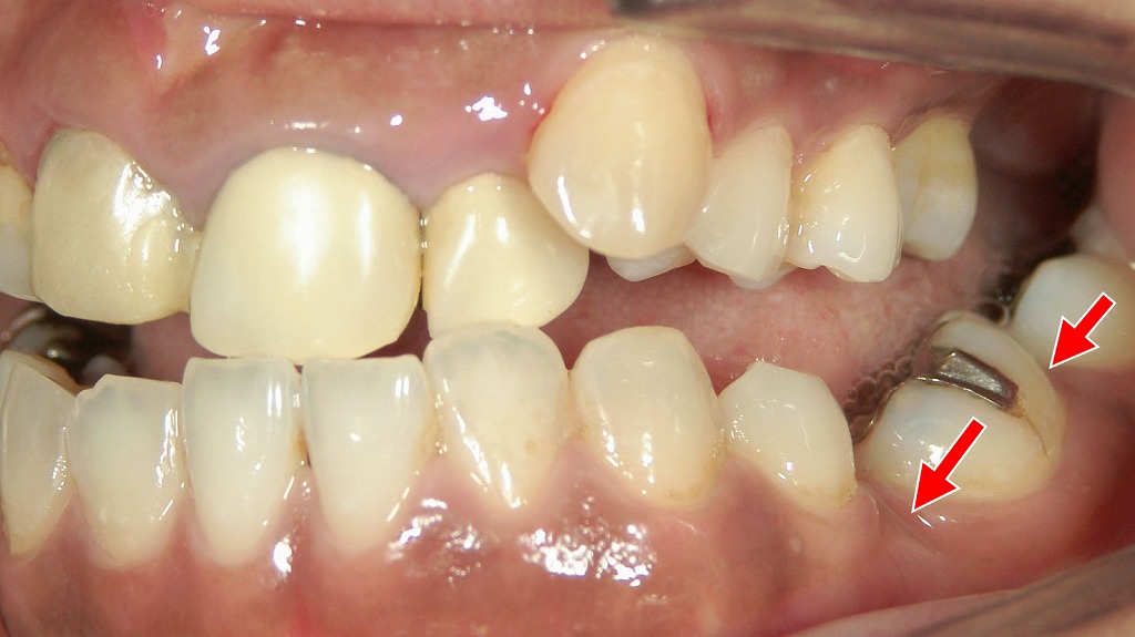 5番抜歯後に生じた6・7番の近心傾斜