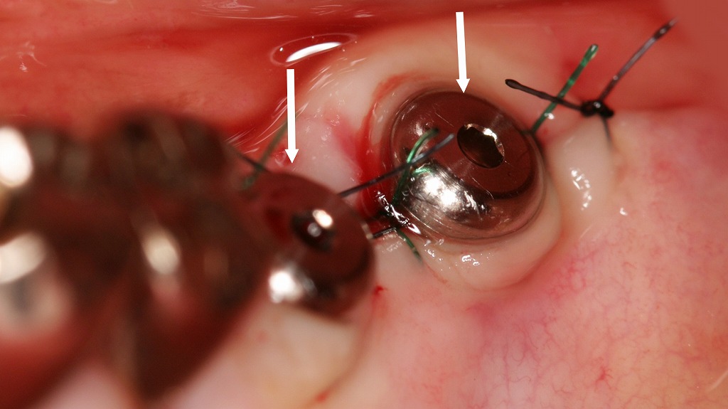 一回法によるインプラント手術直後（縫合完了時）
