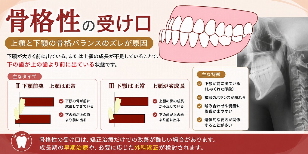 骨格性の受け口