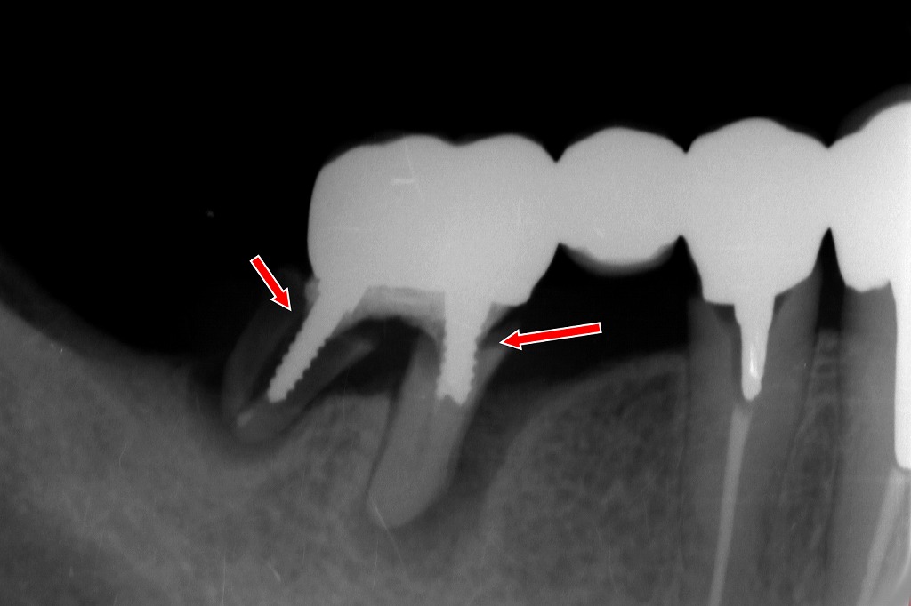 赤矢印部：5・6・7番ブリッジの支台となっている7番の歯に、縦方向の歯根破折を示す透過像を認める。