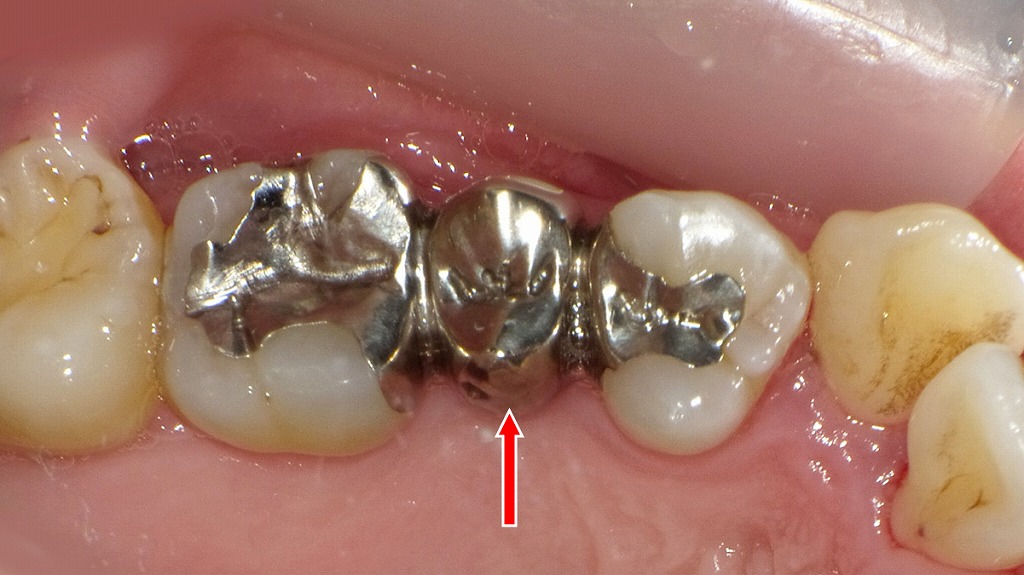 上顎４・５・６番のインレータイプ接着ブリッジ