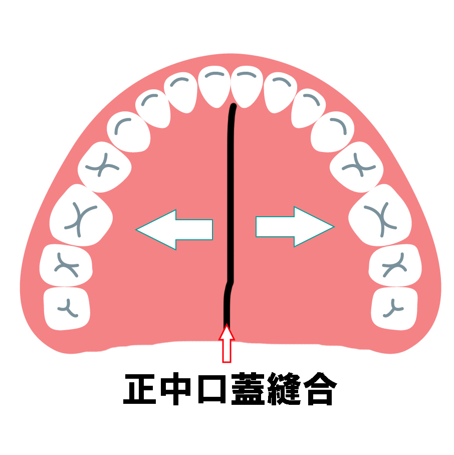 正中口蓋縫合を広げる