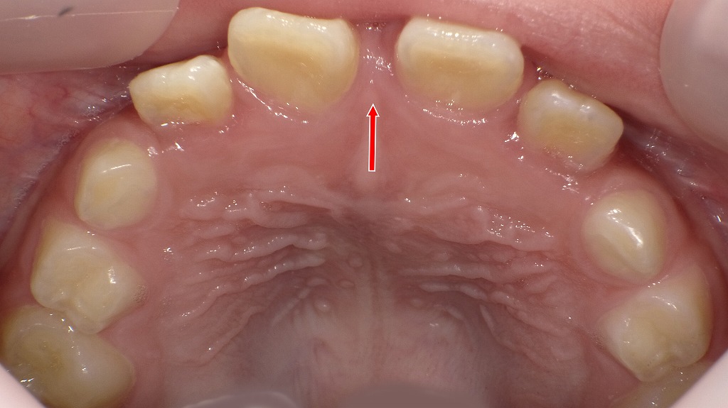 ６歳児のすきっ歯（正中離開）