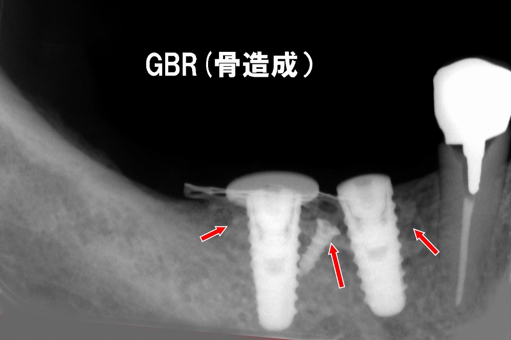 赤矢印：7番抜歯後の骨欠損に対してGBRを実施し、インプラントを2本安定した位置に埋入した状態。