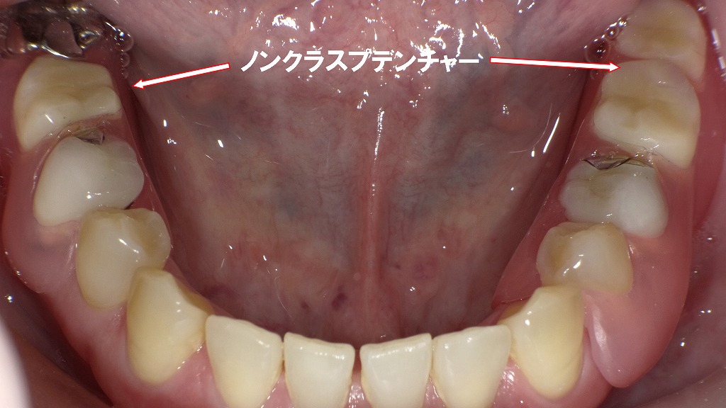 術後：ノンクラスプデンチャー装着
