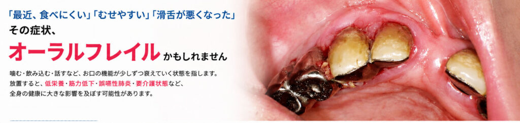 オーラルフレイルとは？