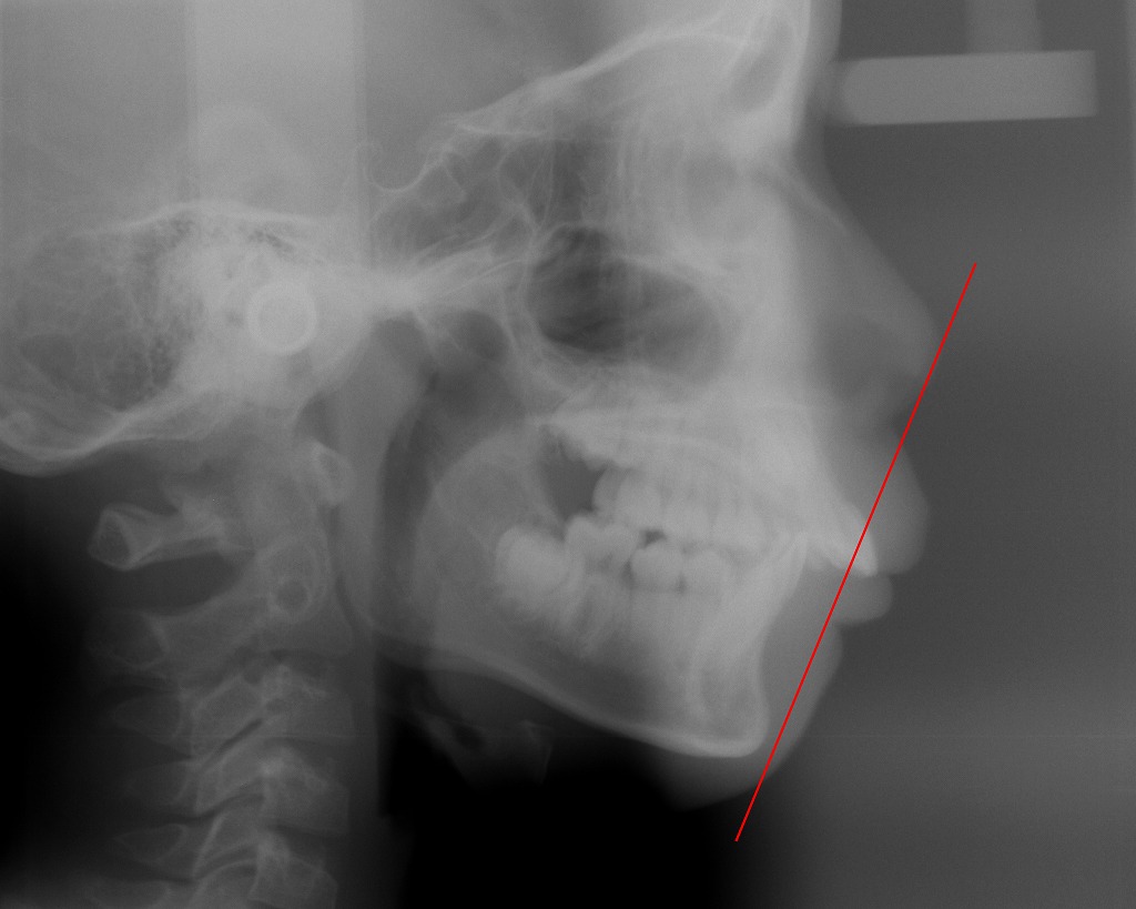 術前／小学校高学年・口ゴボ・上顎前突