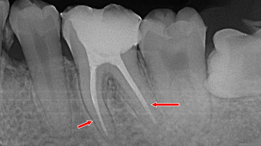下顎6番の根管形態に合わせて緊密に封鎖された精密な根管治療