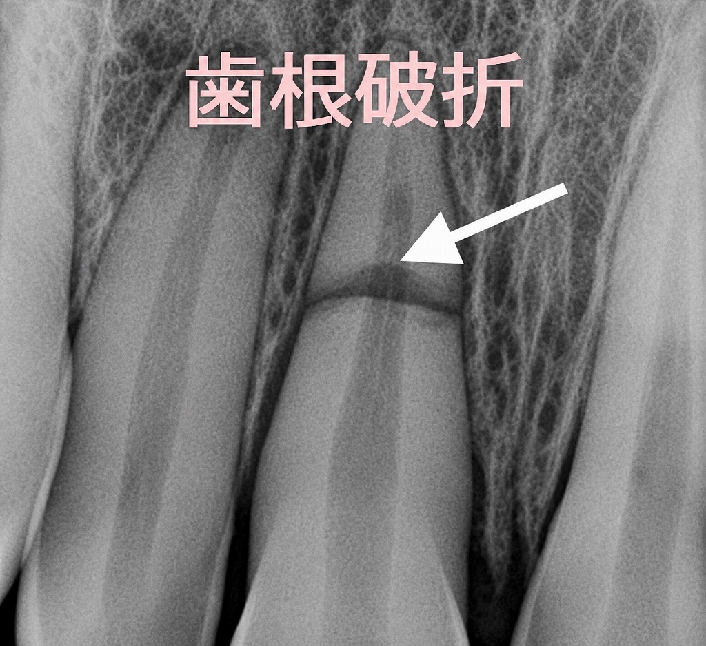 歯根破折