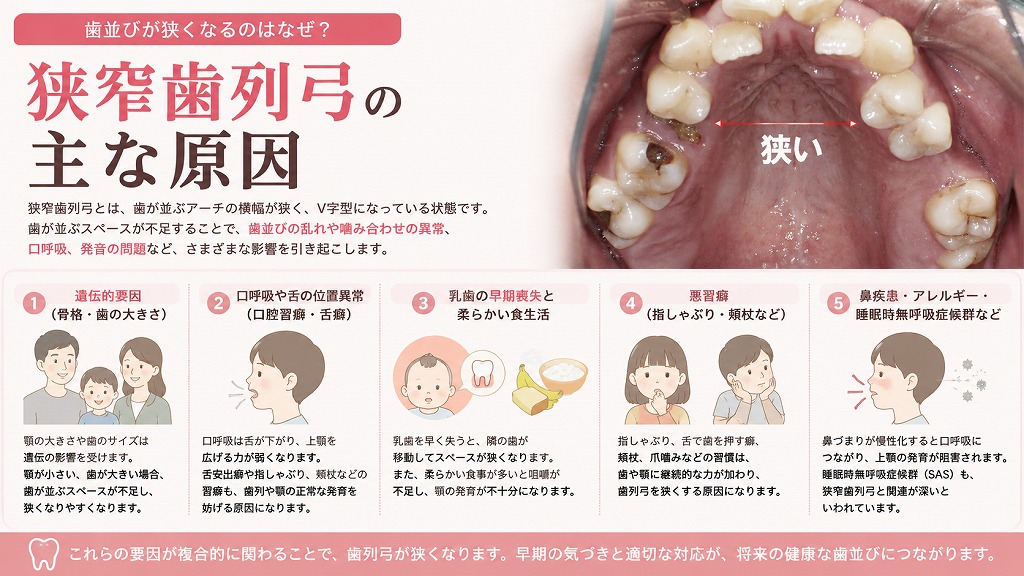 狭窄歯列弓の主な原因