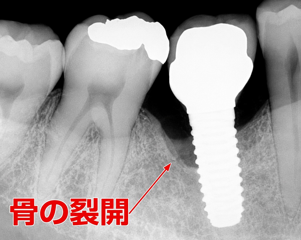 中等度のインプラント周囲炎で骨の吸収