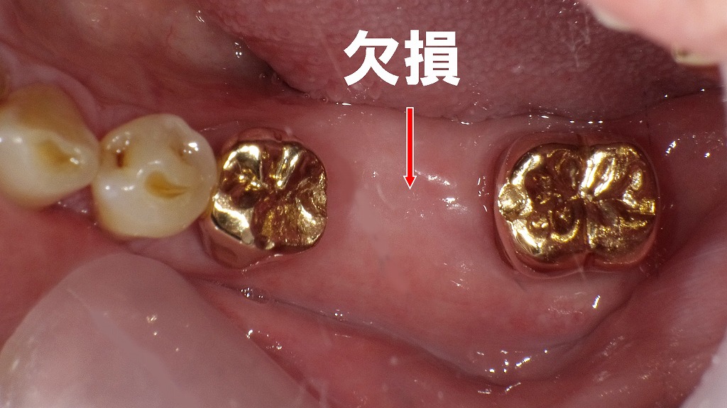 左下6番（第1大臼歯）欠損