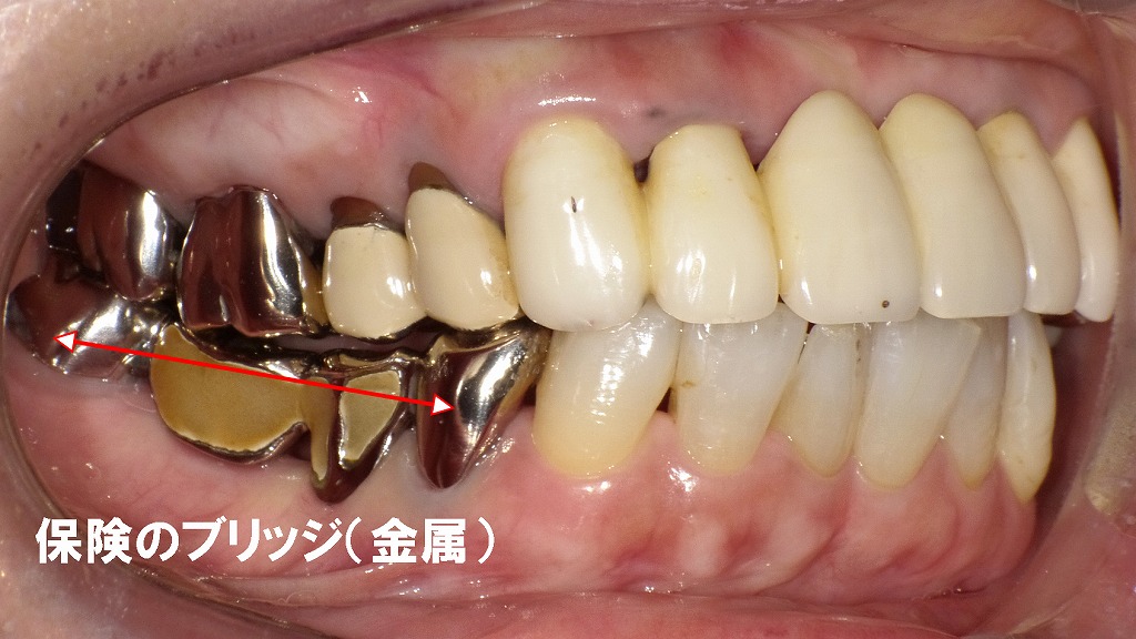 保険適用の奥歯のブリッジ症例