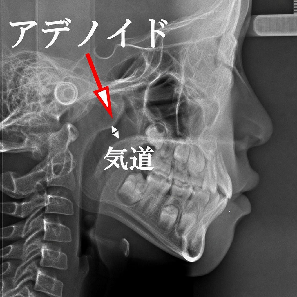 ほぼ正常なアデノイド