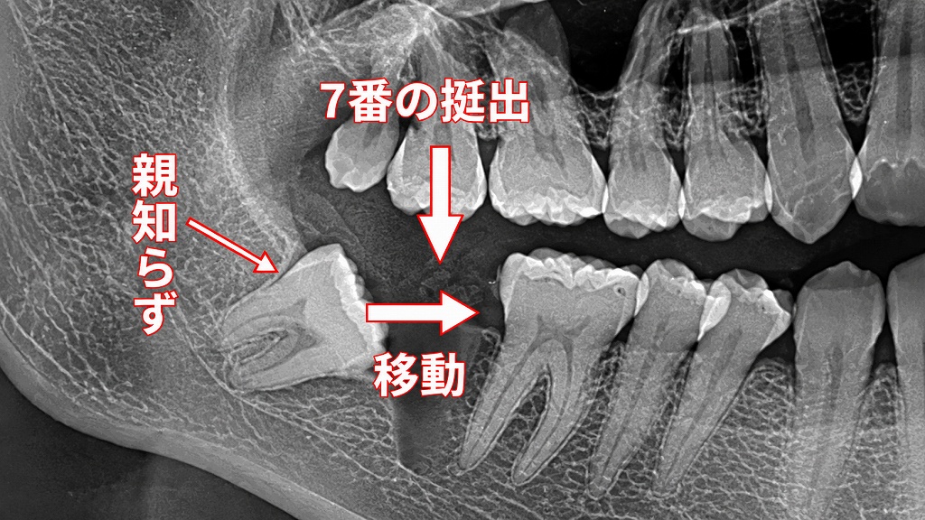 上顎７番の挺出と下顎親知らずの変化