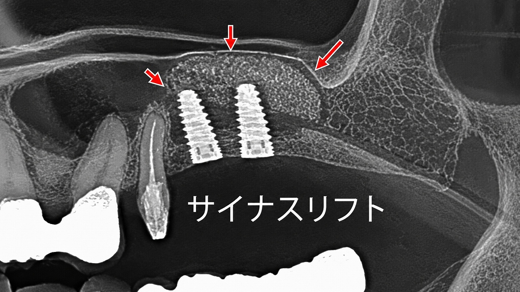 サイナスリフトのレントゲン写真