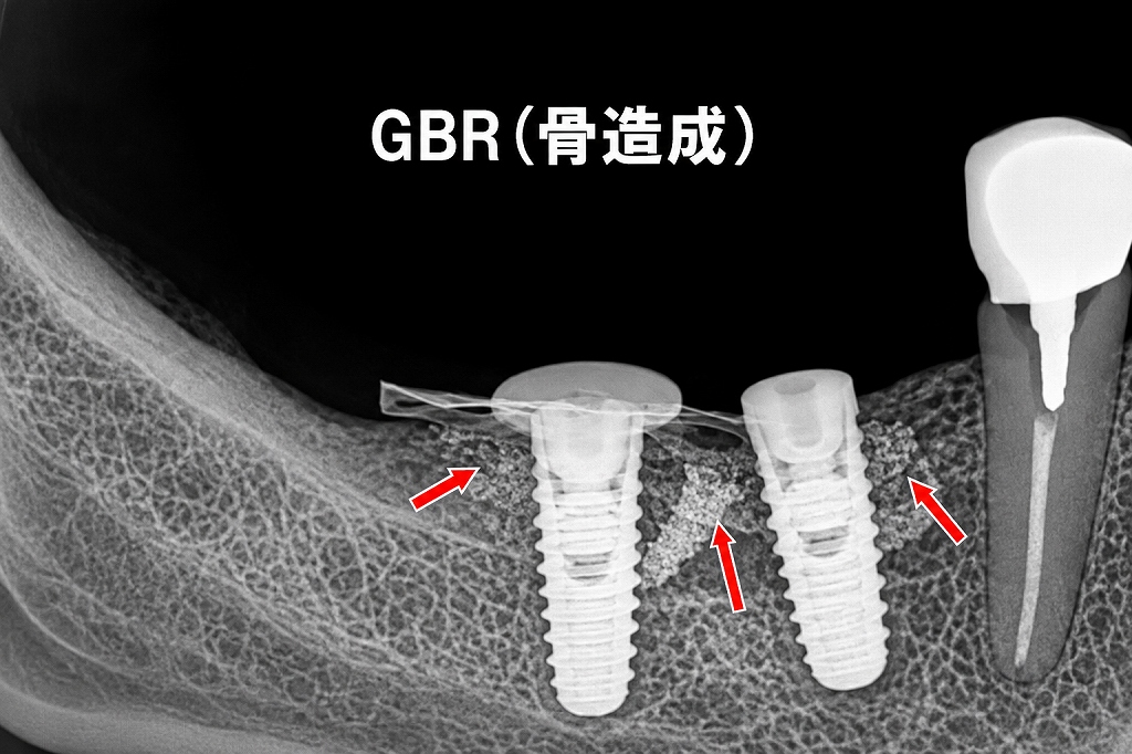 赤矢印：7番抜歯後の骨欠損に対してGBRを実施し、インプラントを2本安定した位置に埋入した状態。
