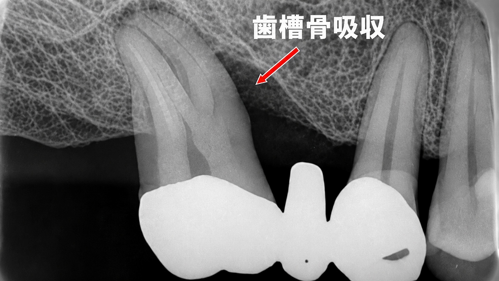 ブリッジを支える歯の歯槽骨が吸収